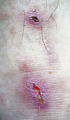 포토 JPG 해외이미지 사람없음 손상 고통 뜨거움 상처 피부 염증 해외202004 해외포토 감정 컨셉 신체부위 질병 파일형식 이미지허브